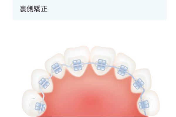 キレイライン矯正HPより裏側矯正